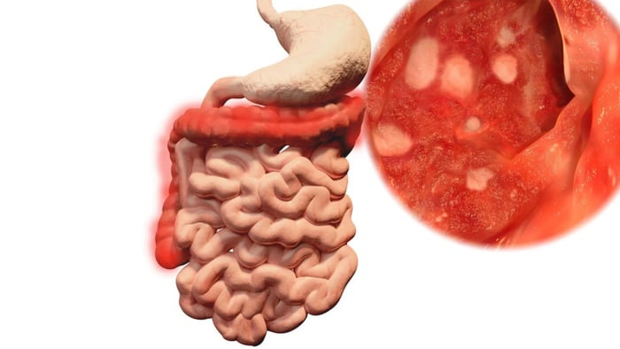 Bệnh viêm ruột Crohn có thể gây ra loét và thủng ruột