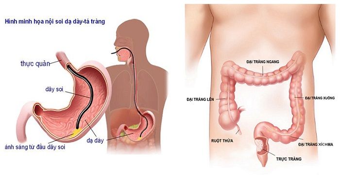 Nội soi dạ dày là phương pháp chẩn đoán bệnh lý dạ dày hiện đại và hiệu quả