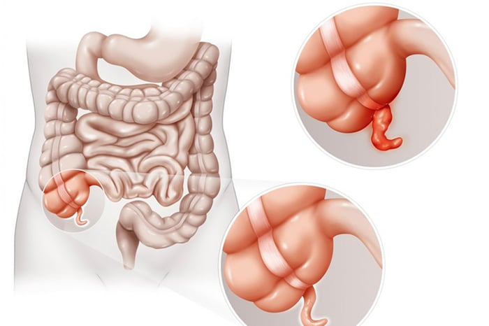 Đau ruột thừa có thể xuất phát từ nguyên nhân hoặc khối u trong ruột