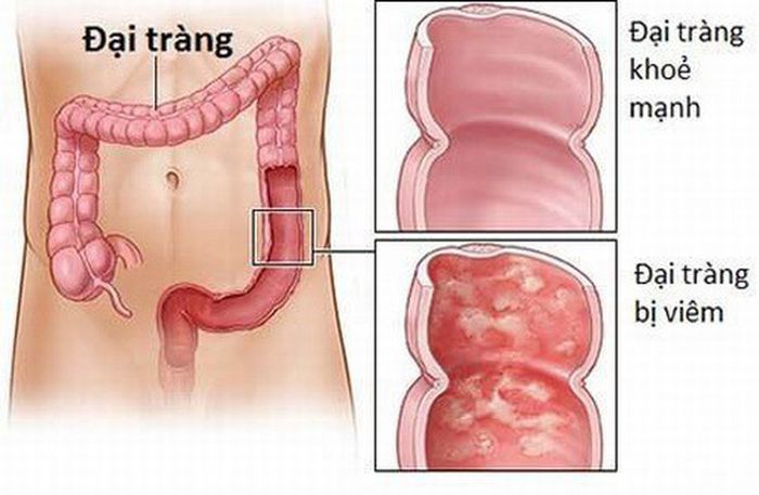 Những người mắc viêm loét đại tràng cần thực hiện nội soi