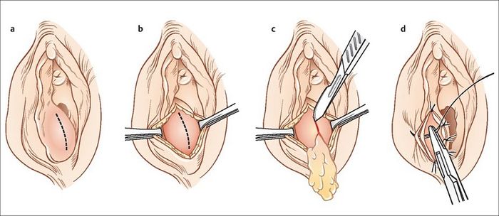 Điều trị bóc tách nang tuyến Bartholin được áp dụng cho các trường hợp có u nang có kích thước lớn.