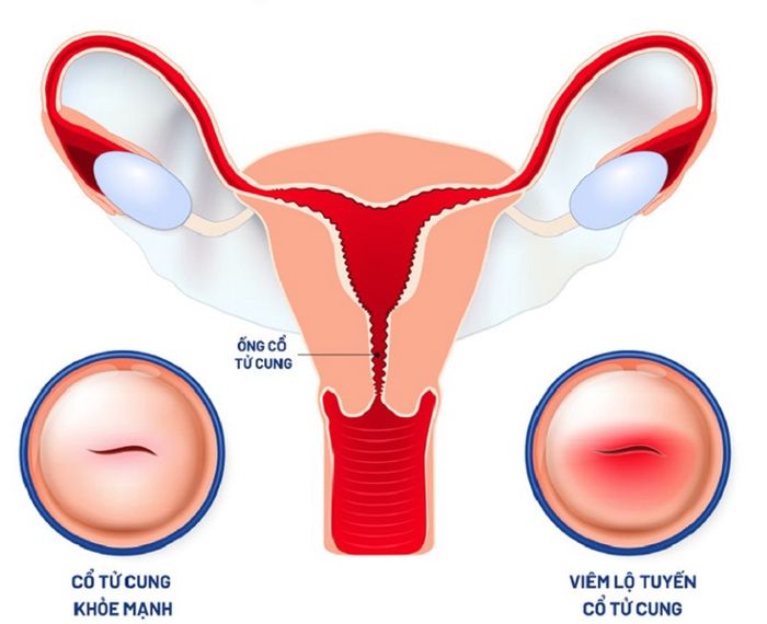 Mô tả tình trạng viêm nhiễm lộ tuyến cổ tử cung