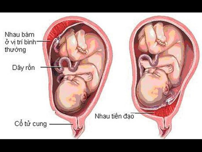 Nhau tiền đạo thường dính vào bên dưới hoặc ngay cổ tử cung