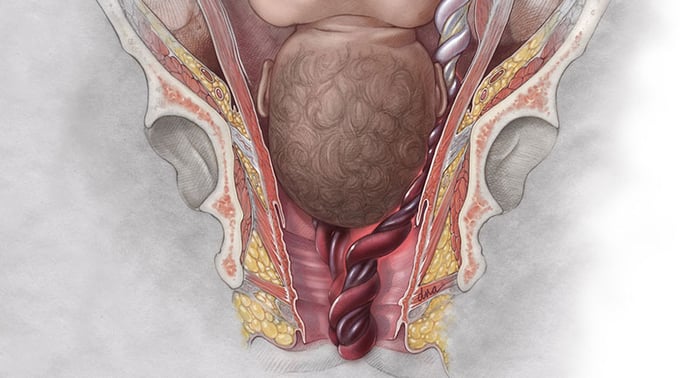 Khái niệm sa dây rốn là gì?