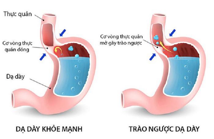 Khi cơ vòng thực quản không đóng lại bình thường, trào ngược dạ dày sẽ xảy ra.