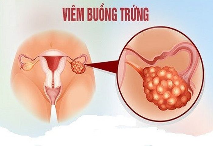 Viêm nang trứng không phải là hiện tượng phổ biến, nhưng đây là một căn bệnh nguy hiểm