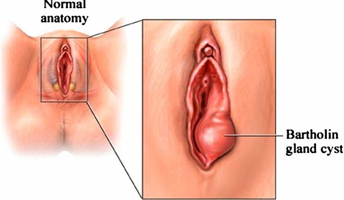 Mô phỏng về bệnh viêm tuyến Bartholin