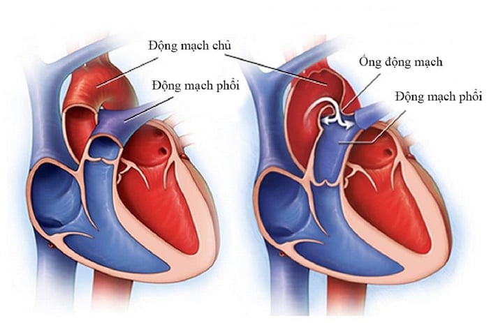 Bệnh tim bẩm sinh cũng là một nguyên nhân khiến phụ nữ mang thai cảm thấy tức ngực.