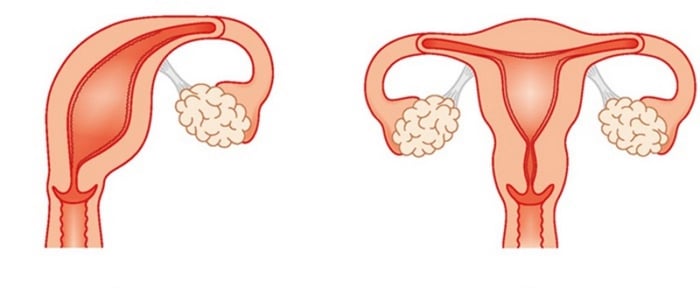 Tử cung hai sừng - Dị tật bẩm sinh phổ biến