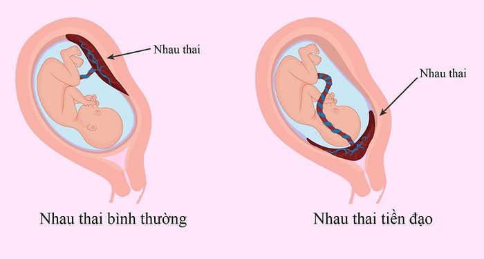 Rau tiền đạo - một trong những vấn đề bất thường về bánh nhau có thể gây nguy hiểm cho thai kỳ