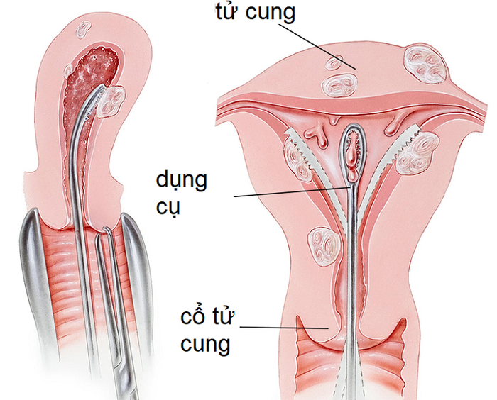 Quá trình nạo hút giúp loại bỏ thai trứng ra khỏi tử cung