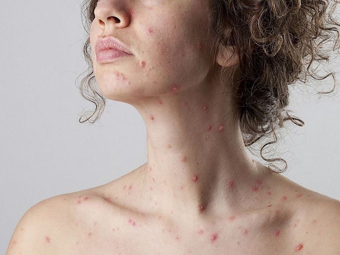 Mọi người đều có thể mắc Rubella