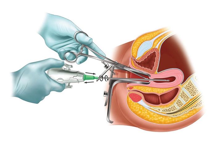 Một trong những nguyên nhân chính gây ra viêm phần phụ là do việc nạo phá thai không an toàn.