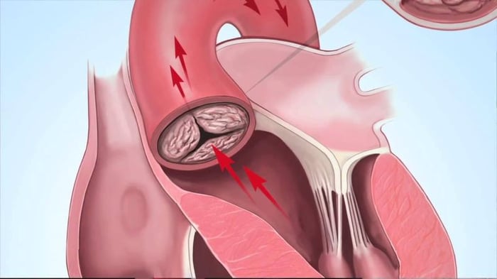 Hẹp hoặc hở van bán nguyệt sẽ dẫn đến rối loạn hoạt động bơm máu từ tim 