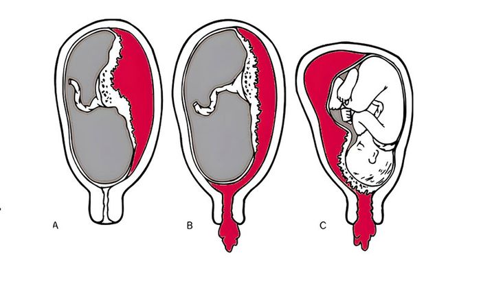 Tóm tắt về tình trạng xuất huyết túi thai ở thai phụ.