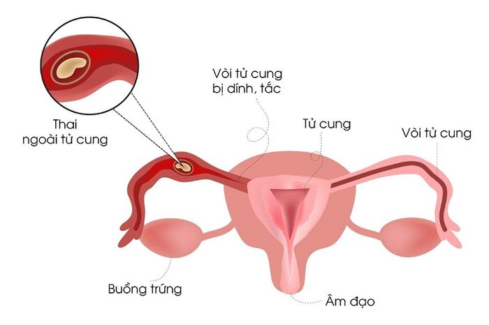 Việc không điều trị viêm phần phụ có thể dẫn đến thai ngoài tử cung ở phụ nữ