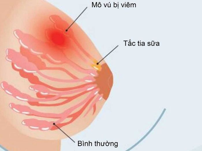 Tắc tia sữa gây ngực mẹ căng đau, nổi cục nhỏ và nóng ran