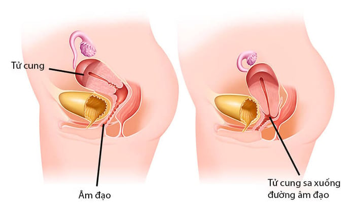 Đối với bệnh nhân mắc chứng bệnh sa sinh dục, việc đặt vòng có thể giúp nâng cao bàng quang, giảm thiểu việc rò rỉ nước tiểu.