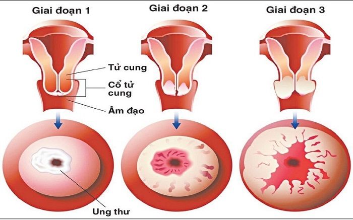 Ung thư cổ tử cung là một trong những bệnh lý phổ biến hiện nay