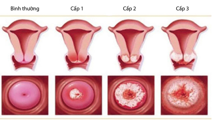 Tình trạng tổn thương do viêm lộ tuyến cổ tử cung theo các cấp độ