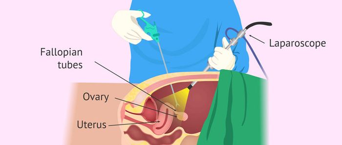 Phẫu thuật nội soi thai ngoài tử cung