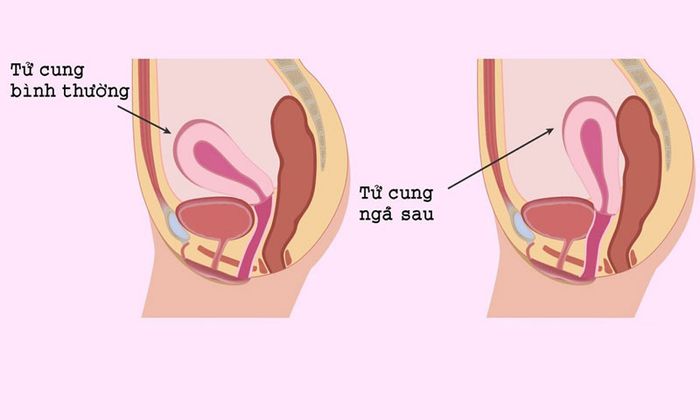 Tử cung ngả sau là hiện tượng gì?