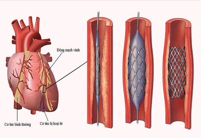 Đặt Stent mạch vành giúp cứu vãn và hồi sinh trái tim