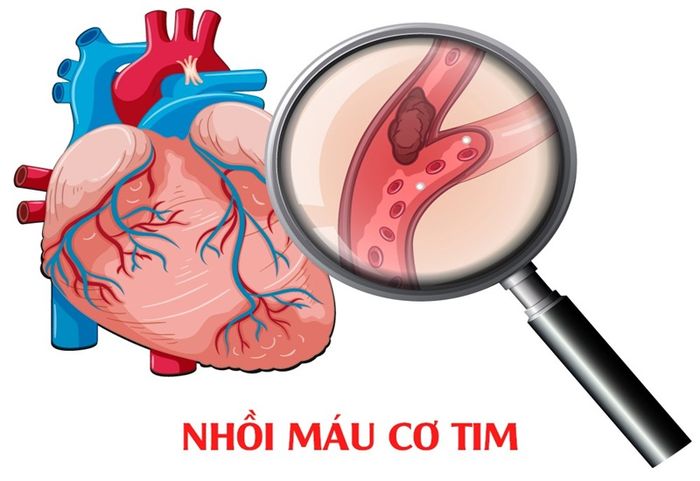 Sử dụng thang điểm TIMI để đánh giá nguy cơ tử vong do nhồi máu cơ tim