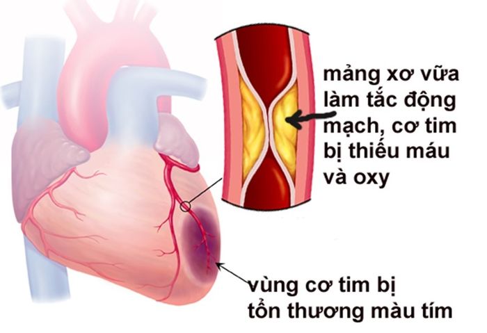 Bệnh tim thiếu máu có nguy hiểm không