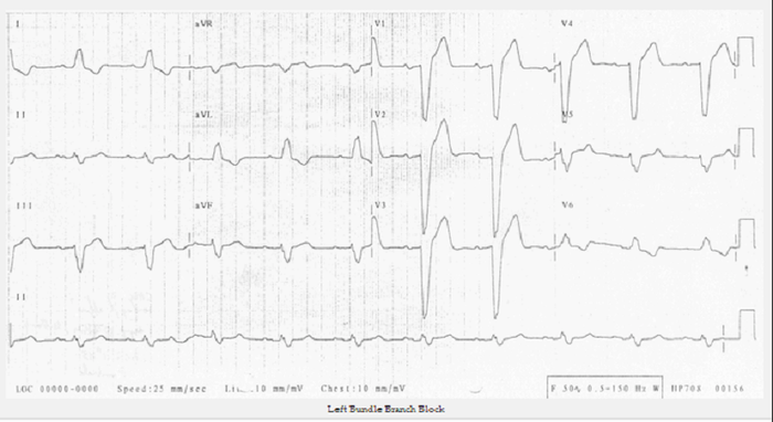 Hình ảnh điện tâm đồ cho thấy tình trạng block nhánh trái
