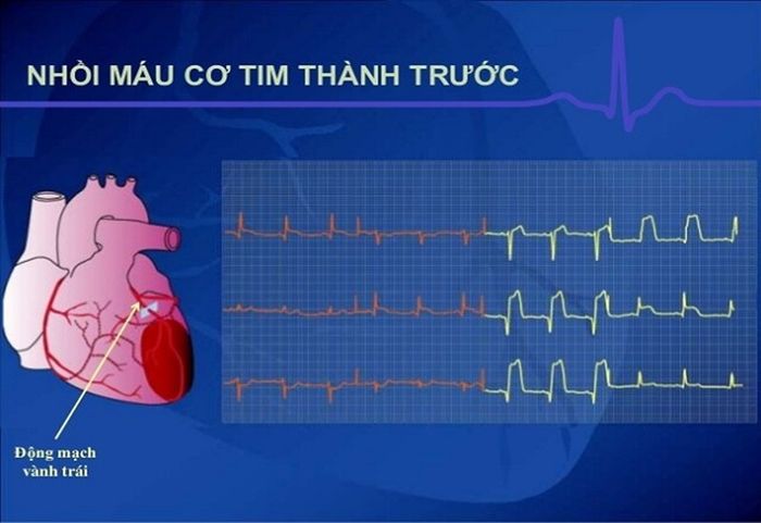 Điện tâm đồ đóng vai trò rất quan trọng trong chẩn đoán nhồi máu cơ tim