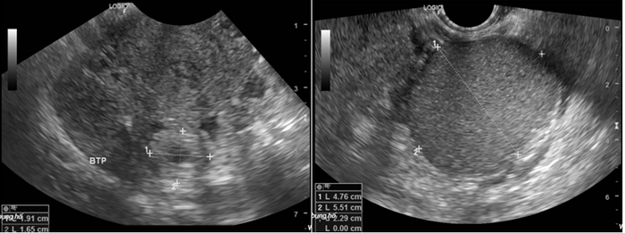 Hình ảnh túi trống âm của buồng trứng phải khi chị T. thực hiện siêu âm