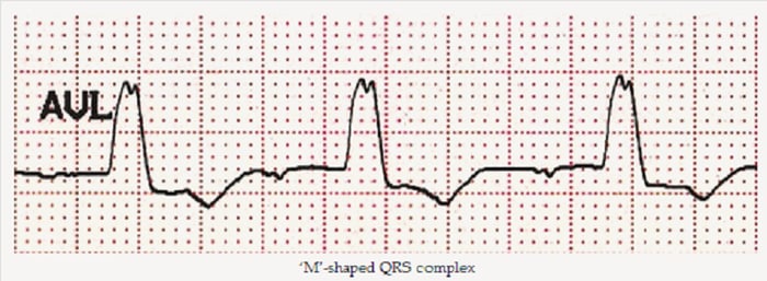 Biểu hiện sóng QRS block nhánh trái trên đồ điện tim