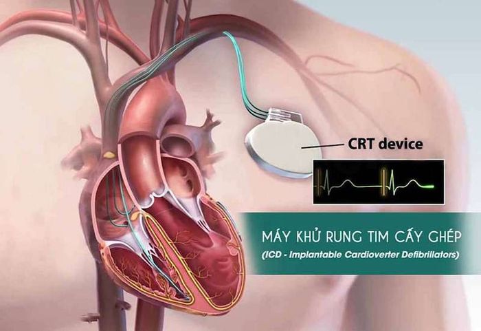 Máy ICD cấy ghép để khử rung tim