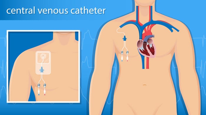 Cần lưu ý một số điều khi đặt catheter vào tĩnh mạch trung tâm.