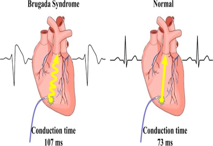 Hội chứng Brugada là một căn bệnh hiếm gặp với tỷ lệ mắc bệnh là 5/10.000 người.