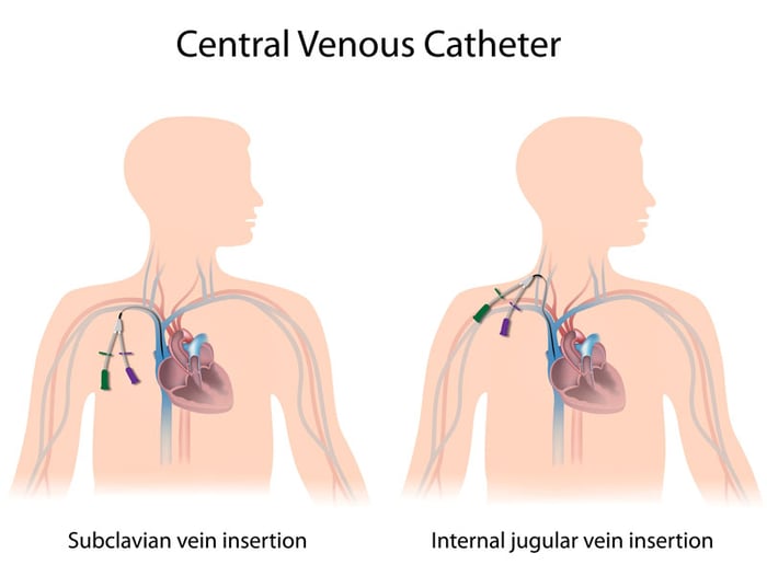 Khi cần cung cấp dinh dưỡng cho bệnh nhân, bác sĩ sẽ sử dụng phương pháp đặt catheter tĩnh mạch