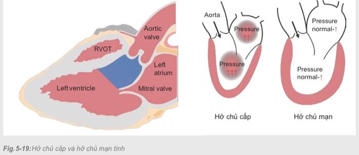 Bệnh nhân cần chú ý khi máu chảy ngược van động mạch chủ