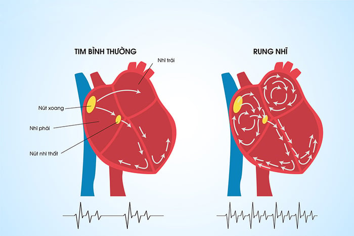 Từ 10% - 30% người mắc WPW thường có dấu hiệu rung nhĩ