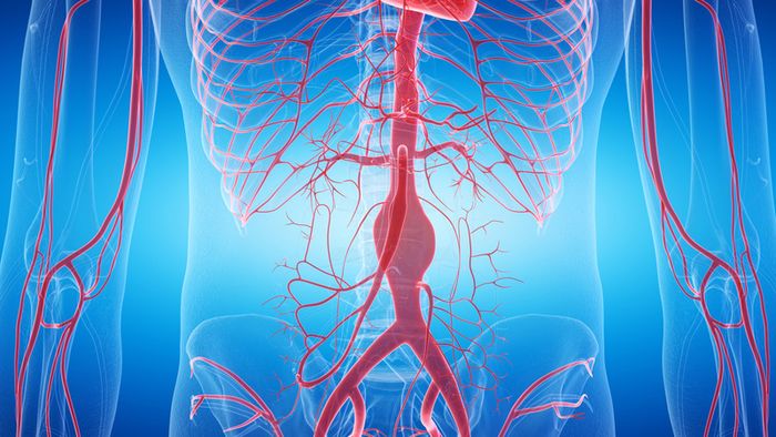 Đặt Stent Graft đang dần thay thế phẫu thuật truyền thống trong việc can thiệp phình động mạch chủ