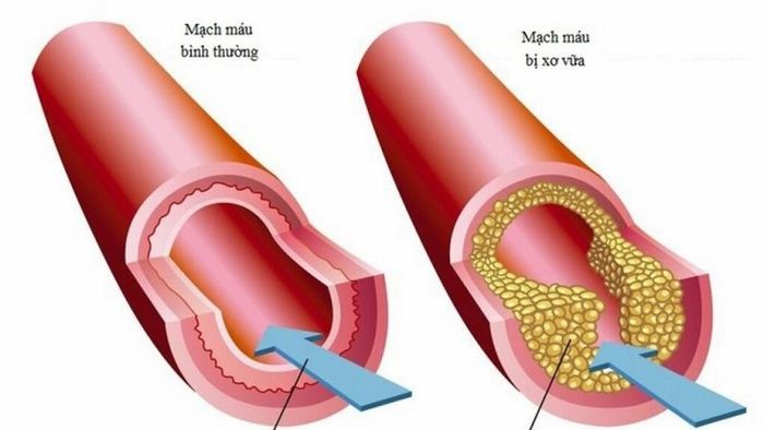 Một số nguyên nhân gây chênh lệch huyết áp ở cả hai tay liên quan đến bệnh tim mạch