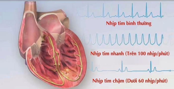 Đốt điện tim là một phương pháp được sử dụng để điều trị cho những bệnh nhân mắc các vấn đề về nhịp tim.