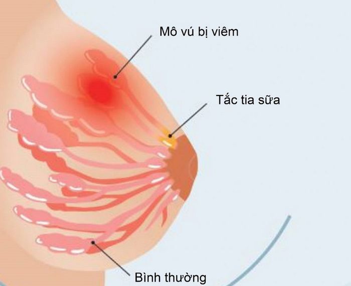 Tắc tia sữa là một trong những vấn đề phổ biến của hậu sản