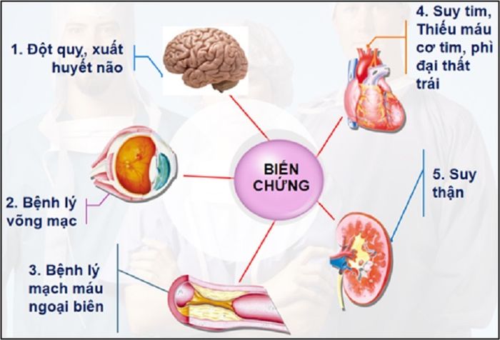 Cao huyết áp nếu không được xử lý kịp thời có thể gây ra nhiều biến chứng nguy hiểm.