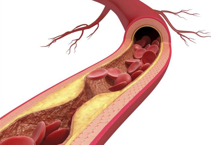 Ngừng hút thuốc lá và tránh xa khói thuốc để giảm nguy cơ đột quỵ.