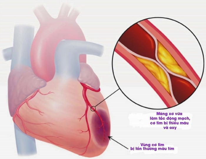 Nhồi máu cơ tim - một trong những nguyên nhân gây block nhánh trái