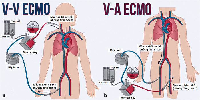 Hệ thống máy sử dụng trong kỹ thuật ECMO