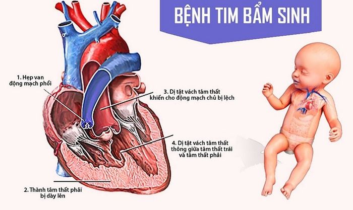 Mô tả về bệnh tim bẩm sinh ở trẻ nhỏ