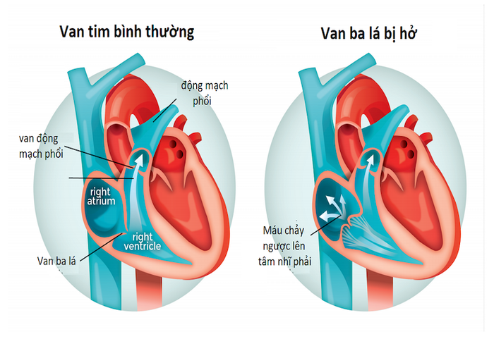 Ví dụ về tình trạng van tim bị hở