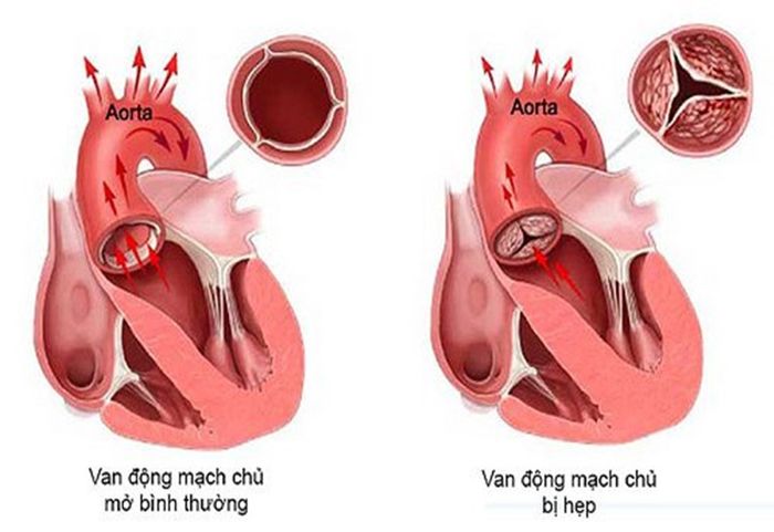 Hẹp van động mạch chủ đang là vấn đề đáng lo ngại